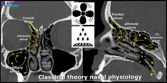 Paranasal Sinuses Ct Scan This Scan Is From A Typical Patient That